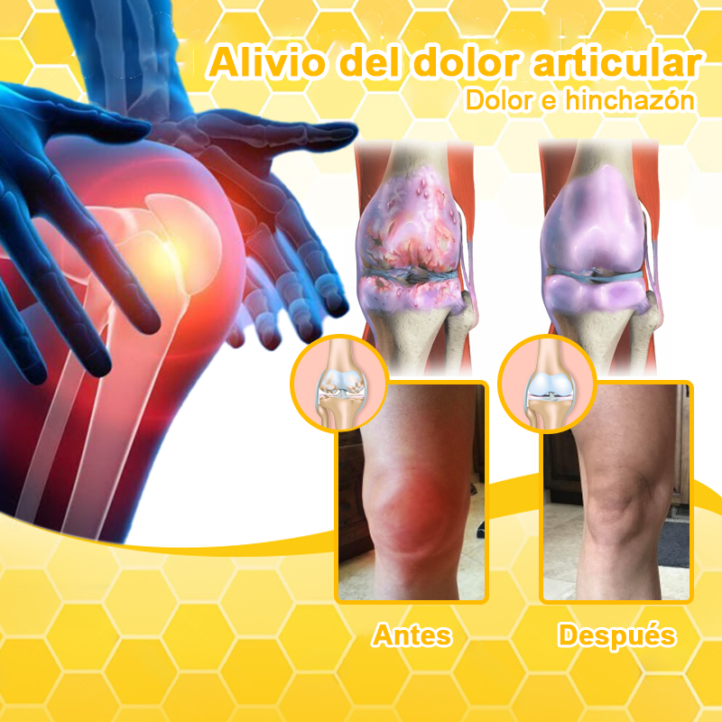 Crema para la terapia de la artritis con veneno de abeja y cúrcuma (👩‍🔬 Especializada en condiciones ortopédicas y dolor articular)